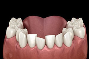 Illustration of crooked teeth