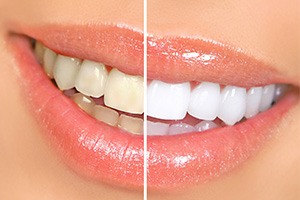 Before and after woman’s teeth whitening treatment